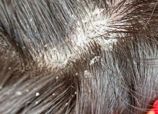 Откуда берётся перхоть и как от неё избавиться