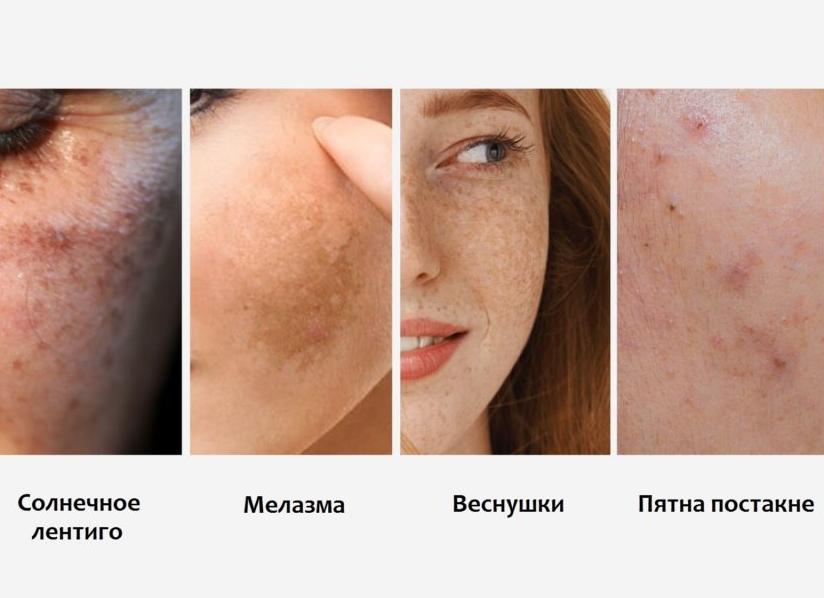 Почему появляются пигментные пятна и как от них избавиться